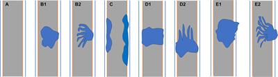 Magnetic resonance imaging features of bile duct adenoma